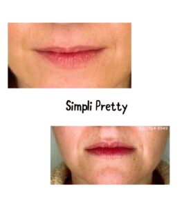 A woman 's lips before and after using the lip filler.